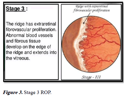 aajcp-Stage 3